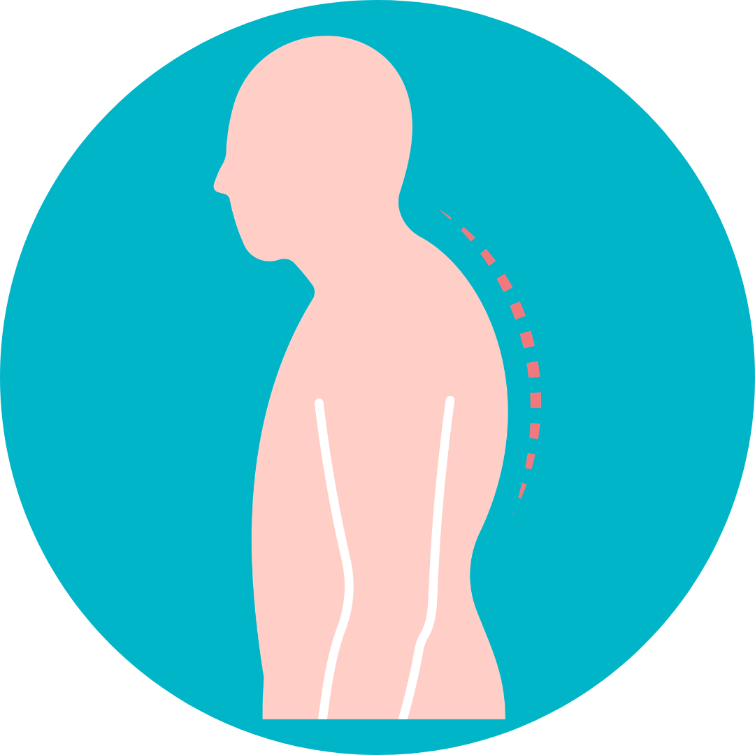 Kyphosis Treatment in Noida | Dr Naveen Pandita