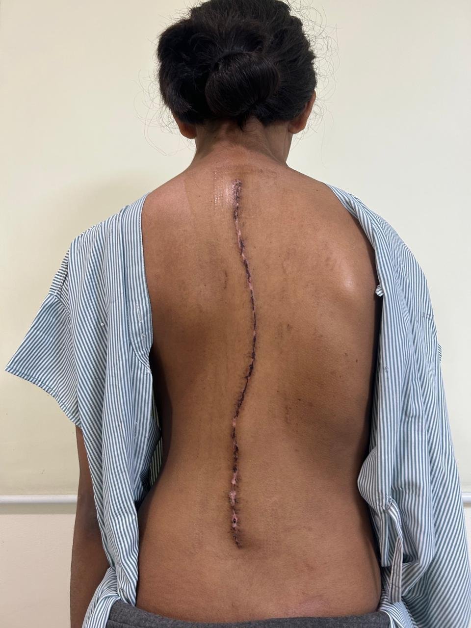 Postoperative scoliosis correction surgery | Scoliosis Surgery Case Study | Dr Naveen Pandita