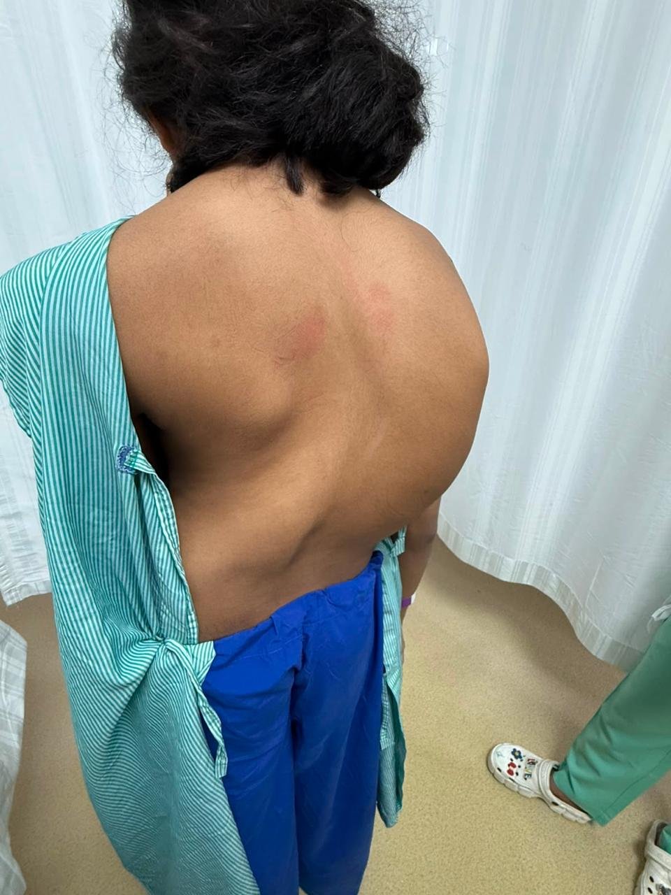 Preoperative spinal deformity and trunk asymmetry | Scoliosis Surgery Case Study | Dr Naveen Pandita