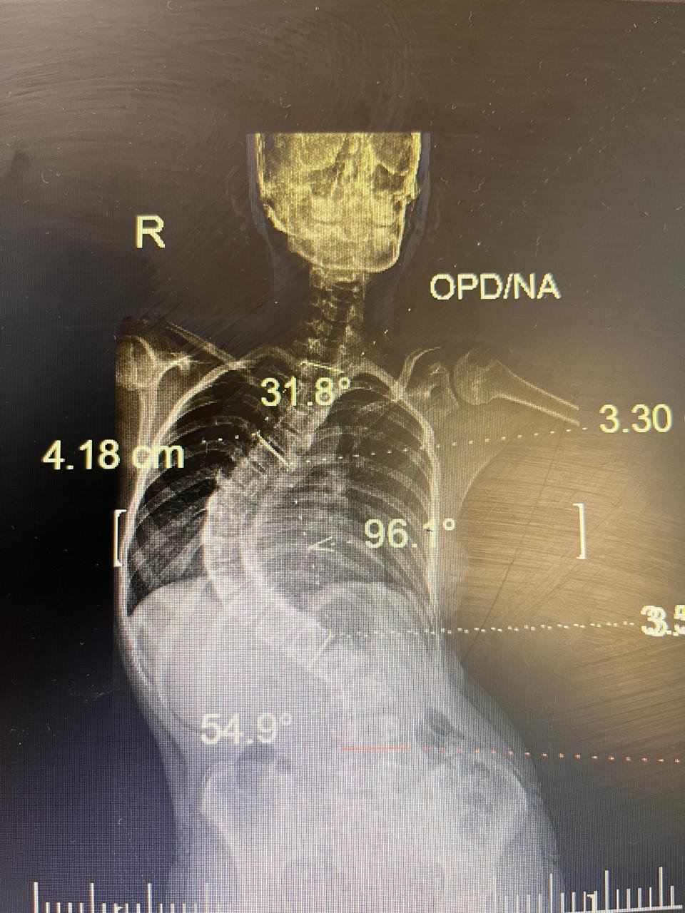 Preoperative X-ray | Scoliosis Surgery Case Study | Dr Naveen Pandita